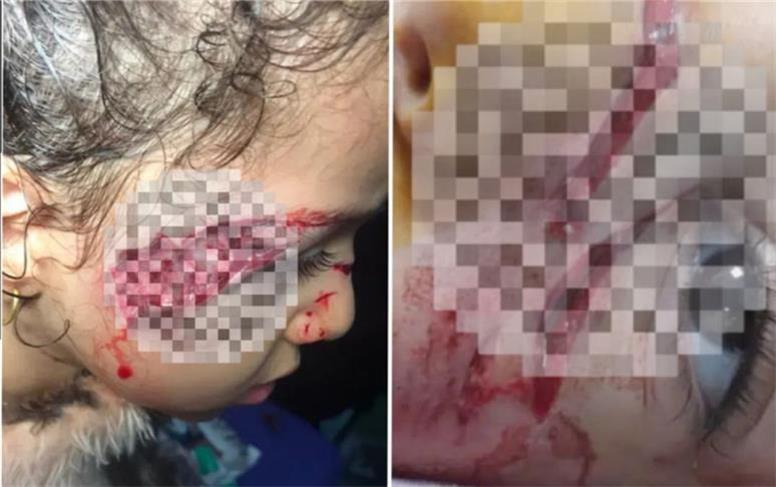 آسیب جدی دختر ۵ ساله بر اثر حمله سگ‌های ولگرد در تبریز