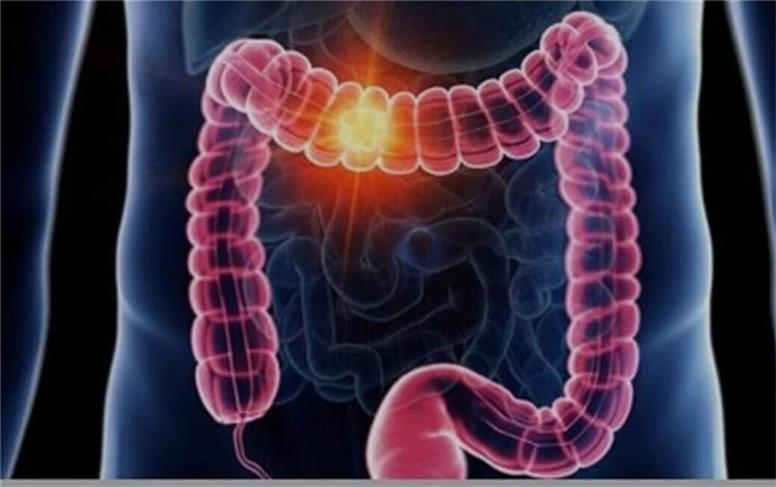 علائم گوارشی را ساده نگیرید/ هر خون‌ریزی هموروئید نیست