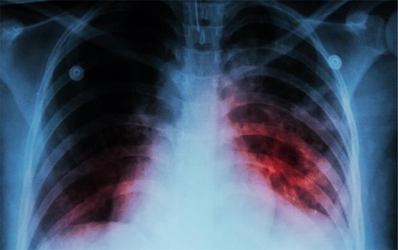 بیماری سل تا چند سال آینده ریشه کن می‌شود؟