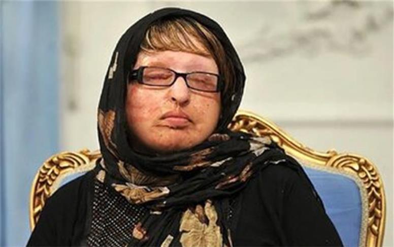حضور یک قربانی اسیدپاشی در دادسرای جنایی تهران