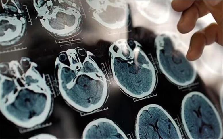 پیش‌بینی ترسناک از آمار آلزایمر در ایران