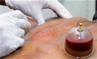 اثر حجامت در بهبود سردردهای میگرنی