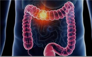 علائم گوارشی را ساده نگیرید/ هر خون‌ریزی هموروئید نیست