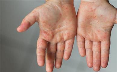 هزار نفر به سرخک مبتلا شده‌اند