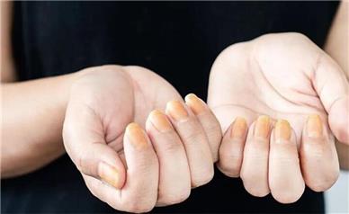 رنگ زرد ناخن نشانه چیست؟