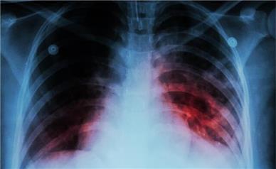 بیماری سل تا چند سال آینده ریشه کن می‌شود؟