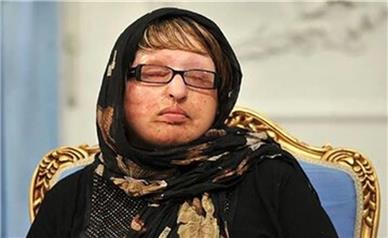حضور یک قربانی اسیدپاشی در دادسرای جنایی تهران